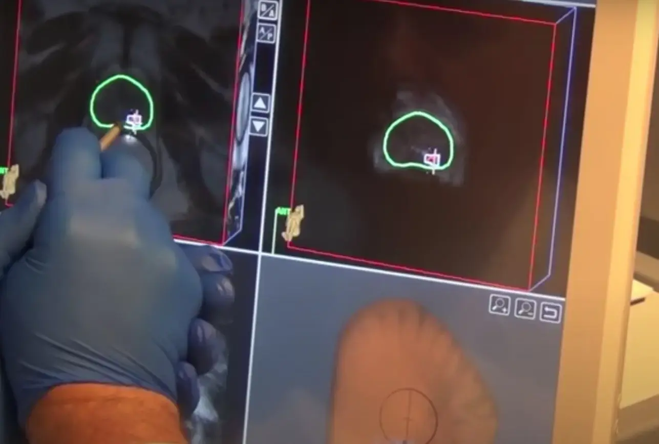 Biopsiile cardiace ar putea fi evitate după transplantul de inimă