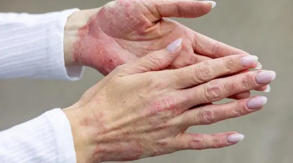 Realitatea nevăzută a psoriazisului: cum afectează boala întregul organism