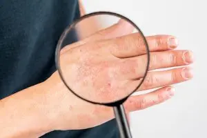 Psoriazisul afectează 400.000 de români, arată estimările specialiștilor